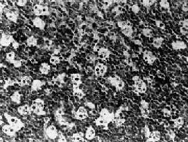 Burkitt�ܰ�<a href=